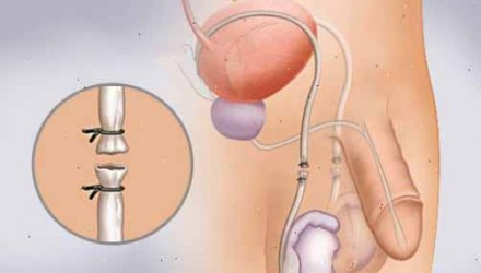especial de vasectomia