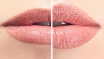 volumen a labios 700x352