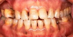 dientes2