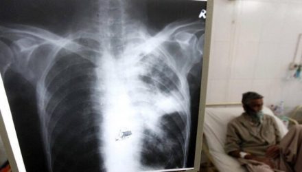tuberculosis en Venezuela