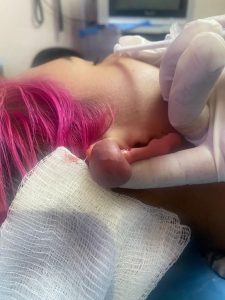 Caso pierde una oreja a caysa de un piercing 2 17d1f017 1026 4fd5 8a54 06d18ab1b0d5