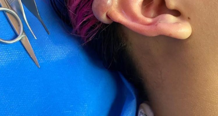 Caso pierde una oreja a caysa de un piercing 1 piercing