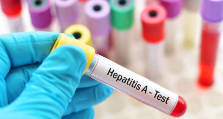 Colombia detectó primer caso de hepatitis aguda de origen desconocido 1 hepatitis