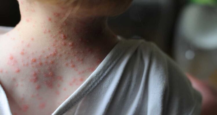 Academia de Medicina pidió tomar previsiones por brote de Viruela de Mono 1 viruela del mono 1
