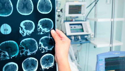 un cerebro con alzheimer