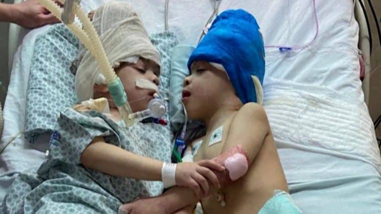 La exitosa cirugía que separó a siameses en Brasil será ofrecida gratuitamente a otros niños de América Latina 4 b25b5a5040d74631aca55137127b7dc2 760x428 1