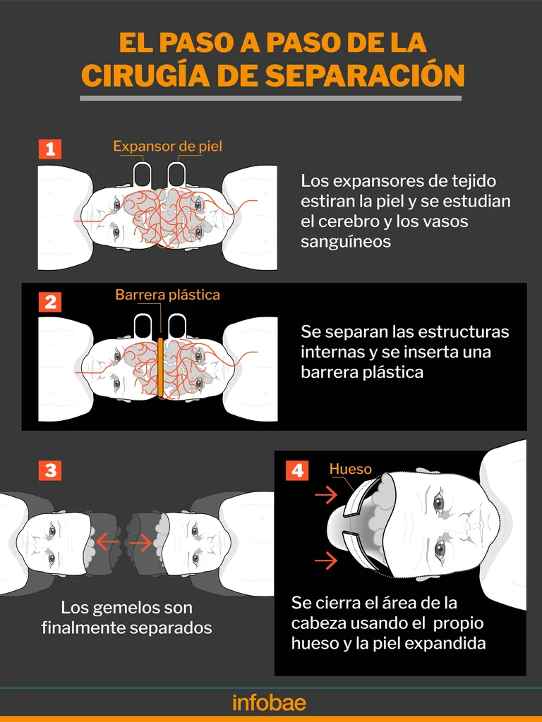La exitosa cirugía que separó a siameses en Brasil será ofrecida gratuitamente a otros niños de América Latina 3 siameses