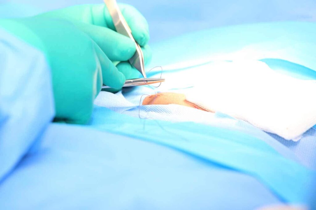 Ingenieros del MIT diseñaron suturas capaces de liberar fármacos o detectar inflamaciones 2 Suturas