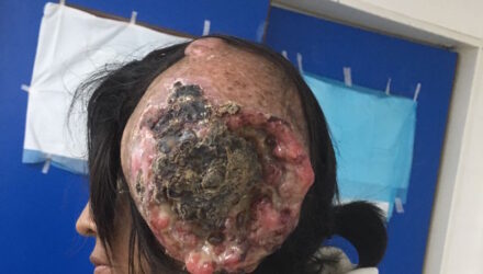 Tumor gigante