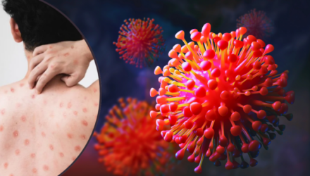 Mpox