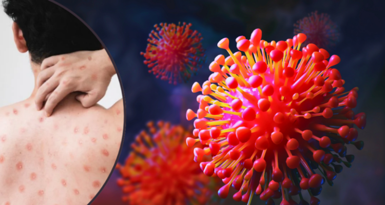 Detectaron el primer caso de mpox en Suecia 1 Mpox
