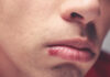 herpes