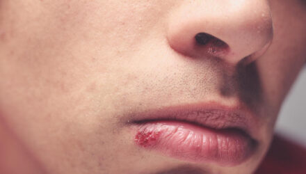 herpes