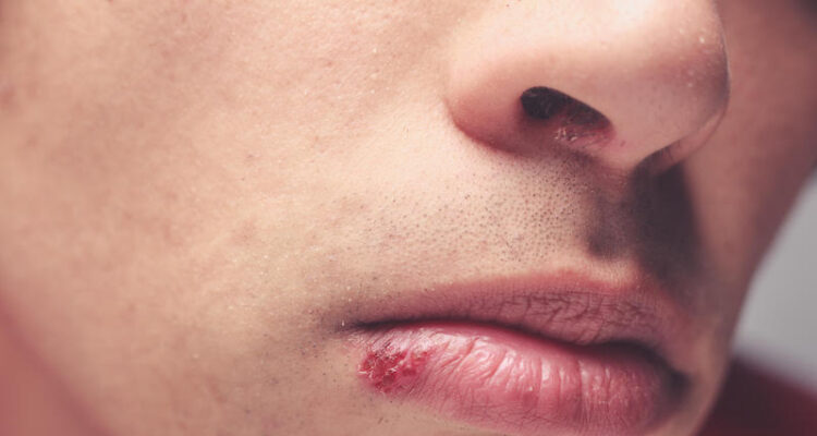 herpes