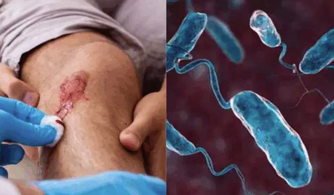 Alerta en EE. UU.: Van ocho muertos y 31 infectados por bacteria marina carnívora 1 Bacteria