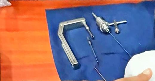 Primer clavo de pelvis fue creado por médicos venezolanos 3 pro atyNIIyt