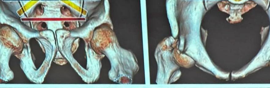 Primer clavo de pelvis fue creado por médicos venezolanos 4 pro