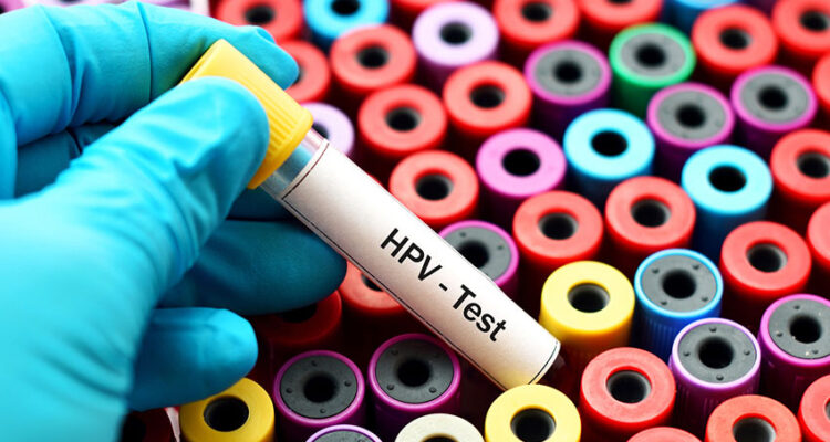 Un algoritmo de Harvard es capaz de descubrir el cáncer de VPH antes que los síntomas 1 VPH