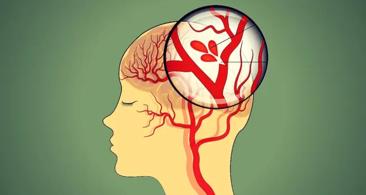 Estudio revela peligrosa conexión entre encías enfermas y el accidente cerebrovascular 1 Encías