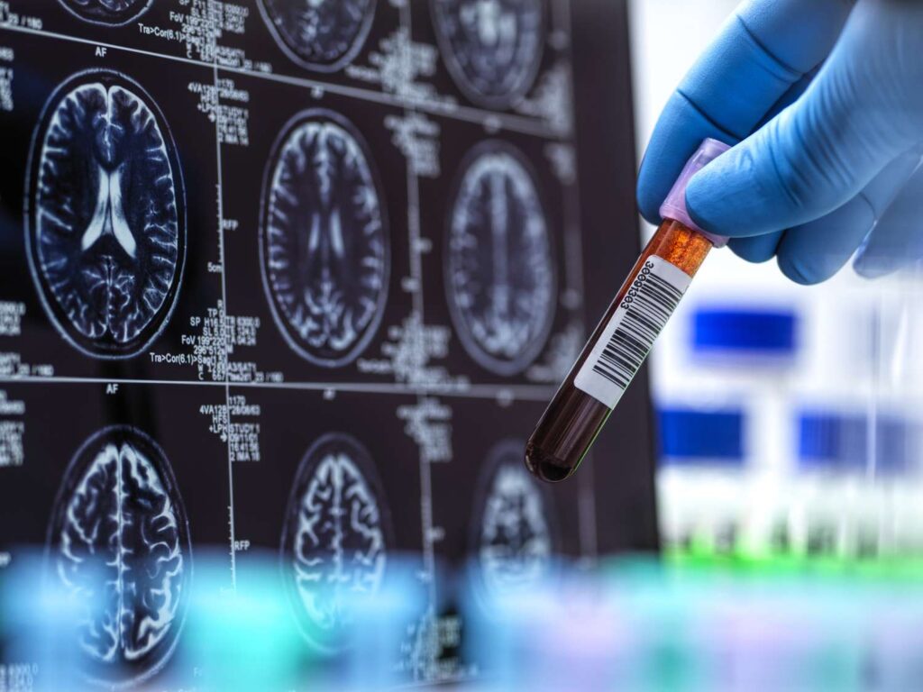 Los análisis de sangre para detectar el Alzheimer ya son una realidad 2 Alzheimer prueba de sangre