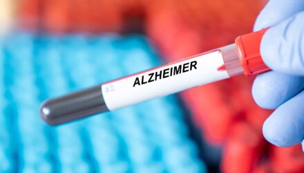 Alzheimer.