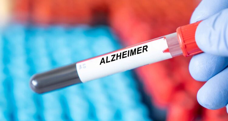 Los análisis de sangre para detectar el Alzheimer ya son una realidad 1 Alzheimer.
