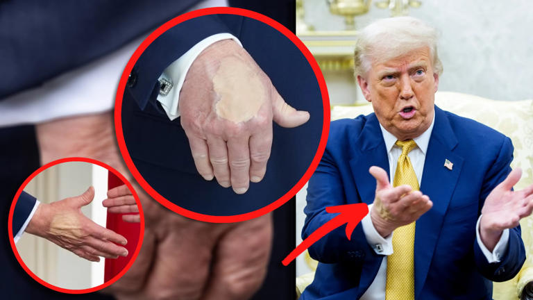 Moretones en las manos de Trump generan especulaciones sobre su salud 2 AA1L8oEL