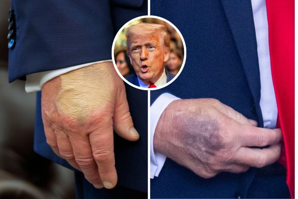 Moretones en las manos de Trump generan especulaciones sobre su salud 3 mao roxa de trump 1