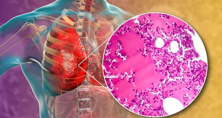 ¿Peste neumónica en Rusia? Esto es lo que se sabe 1 Peste